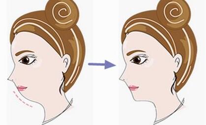 吉林面部粗糙光子嫩膚價位表收費目錄一覽(吉林姬安娣醫(yī)療美容診所面部粗糙光子嫩膚參考價：4311元)