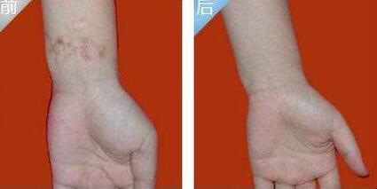 太原招風(fēng)耳糾正價格