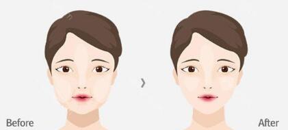 成都光子嫩膚改善皮膚粗糙全新整形價(jià)格表(成都潤玉之光醫(yī)療美容醫(yī)院光子嫩膚改善皮膚粗糙參考價(jià)：3401元)