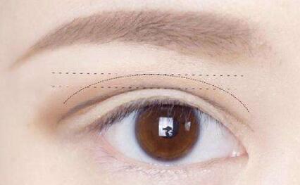 馬鞍山隆下巴整形價格