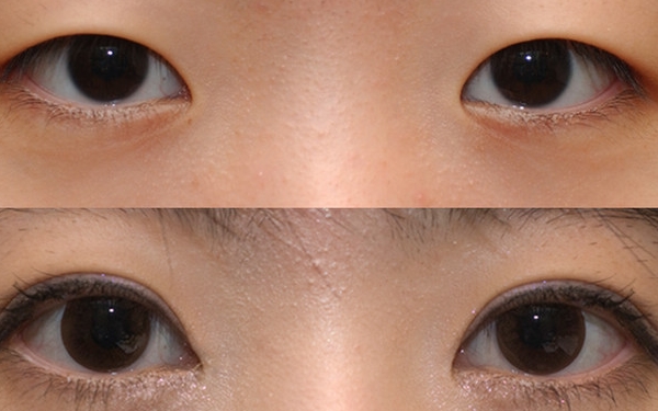 吉林眼袋抽脂價(jià)格