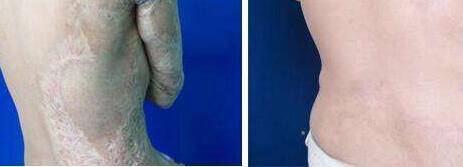 吉林光電治療打頸紋整形外科價格全新來襲(吉林大學第一醫(yī)院整形外科光電治療打頸紋參考價：5658元)