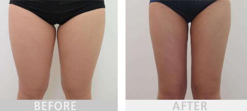 杭州大腿太粗用溶脂針的價格一般要多少錢(杭州嘉禾整形美容醫(yī)院大腿太粗用溶脂針參考價：3002元)