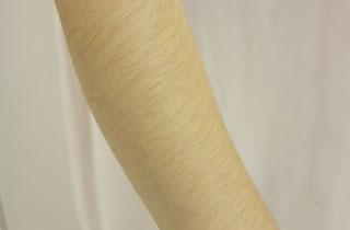 昆山光電去除眼周紋價格