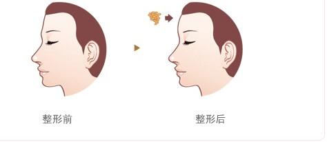 佛山小拉皮去眼睛細(xì)紋的報(bào)價(jià)新版收費(fèi)標(biāo)準(zhǔn)一欄(佛山是美萊醫(yī)療美容醫(yī)院小拉皮去眼睛細(xì)紋參考價(jià)：3552元)