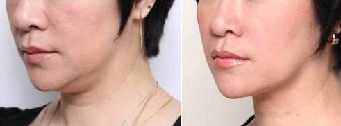 德州表情紋注射玻尿酸手術(shù)費(fèi)公布(德州百佳婦嬰醫(yī)院表情紋注射玻尿酸參考價：5663元)