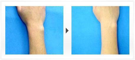 福州瘦臉針面部吸脂的價格大概需要多少錢合理(福州渙美醫(yī)學(xué)整形美容醫(yī)院瘦臉針面部吸脂參考價：3119元)