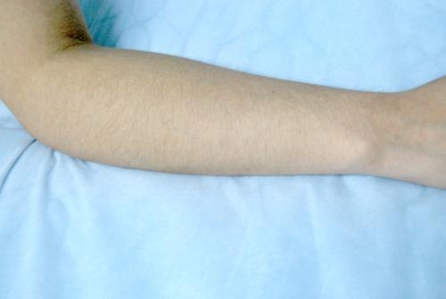 重慶點陣激光祛額頭紋手術(shù)價格表明細(重慶康雅整形美容醫(yī)院點陣激光祛額頭紋參考價：5051元)