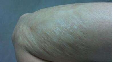 石家莊頸部皺紋祛除手術(shù)價(jià)格