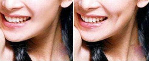 湖南澳洲POLA美白治療價格在線查詢(中南大學(xué)湖南湘雅醫(yī)院整形科澳洲POLA美白參考價：6752元)