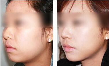 深圳干細(xì)胞去妊娠紋收費(fèi)價(jià)目表上線(深圳南雅醫(yī)療美容門診部干細(xì)胞去妊娠紋參考價(jià)：3136元)