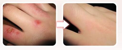 云南自體脂肪移植術大概多少錢合適(云南省前列人民醫(yī)院自體脂肪移植術參考價：3721元)