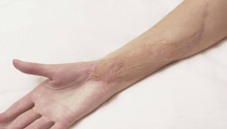 寧波去眼睛細(xì)紋手術(shù)的價(jià)格大概需要多少錢(qián)(寧波童顏依美醫(yī)療美容門(mén)診去眼睛細(xì)紋手術(shù)參考價(jià)：5034元)