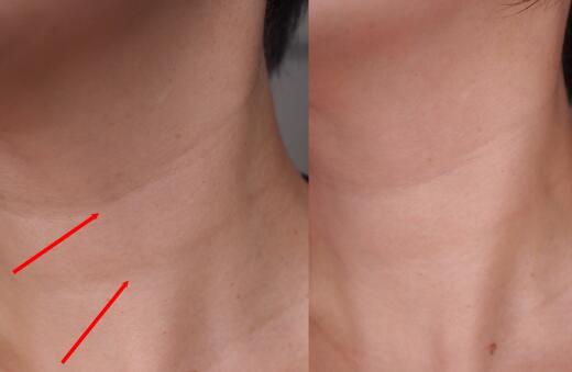 蘭州脂肪額頭紋填充價格