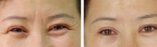 上海愛(ài)貝芙祛魚(yú)尾紋價(jià)格信息剖析(上海真美婦科醫(yī)院整形科愛(ài)貝芙祛魚(yú)尾紋參考價(jià)：6944元)