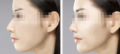 新疆黑臉娃娃祛痘印手術(shù)費(fèi)用清單上線(新疆星辰格林整形美容醫(yī)院黑臉娃娃祛痘印參考價(jià)：6405元)