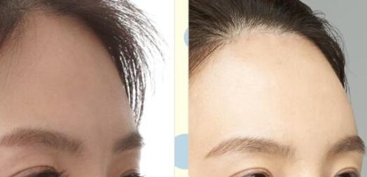 武漢手術(shù)祛川字紋報(bào)價(jià)(武漢漢城整形醫(yī)院手術(shù)祛川字紋參考價(jià)：4267元)