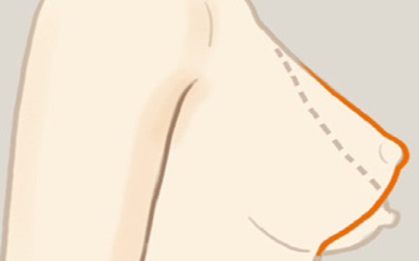 石家莊膨體假體隆鼻價格