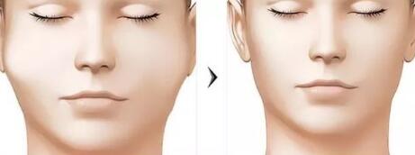 廣東淚溝填充嗨體價格明細同步一覽(廣東省中醫(yī)醫(yī)院淚溝填充嗨體參考價：3100元)