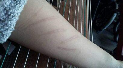 蘭州負壓吸脂瘦手臂收費價目表明細流出(甘肅蘭州錦華美容醫(yī)院負壓吸脂瘦手臂參考價：6969元)