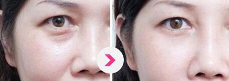 成都玻尿酸填充頸紋價(jià)格表大全(第成都友誼整形醫(yī)院玻尿酸填充頸紋參考價(jià)：6323元)