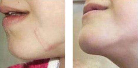 濟(jì)南眼皮皮膚松弛2023價(jià)格價(jià)目表明細(xì)查詢(山東濟(jì)南伊美爾醫(yī)療美容醫(yī)院眼皮皮膚松弛參考價(jià)：6081元)