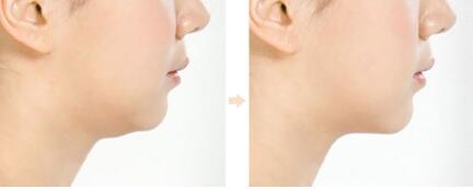 蕭山皮秒抗衰除皺2023全新價(jià)格表推出(杭州蕭山商城醫(yī)療美容門診部皮秒抗衰除皺參考價(jià)：4375元)