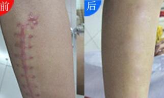 海口微整祛皺一般費(fèi)用一覽表(?？谀w康中醫(yī)皮膚病醫(yī)院微整祛皺參考價(jià)：3779元)