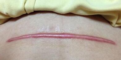 開封膠原蛋白注射填充去痘疤收費標(biāo)準(zhǔn)明細(xì)公布(開封晴美醫(yī)療美容膠原蛋白注射填充去痘疤參考價：5459元)