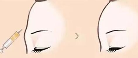 銀川肉毒素祛眼角紋價(jià)位表標(biāo)準(zhǔn)更新(銀川坤唐醫(yī)療美容肉毒素祛眼角紋參考價(jià)：3919元)