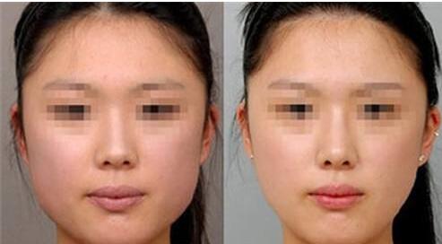 北京下巴填充嗨體價(jià)格