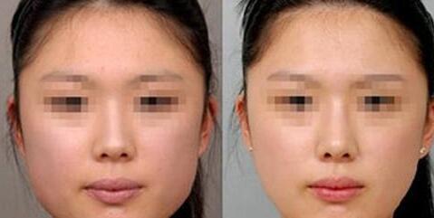 長沙做去黑痣報價整形費用(長沙欣姿美醫(yī)療美容門診部做去黑痣?yún)⒖純r：4703元)