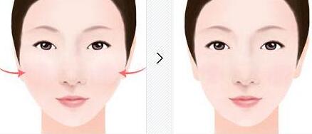 新鄉(xiāng)激光去黑色素痣的手術(shù)費用需要多少錢合理(新鄉(xiāng)371醫(yī)院整形美容科激光去黑色素痣?yún)⒖純r：3208元)