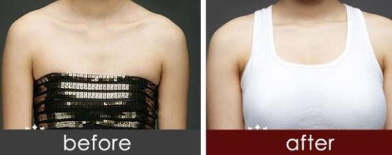 武漢小腿射頻溶脂的價格是多少查詢如下(武漢第二醫(yī)院整形外科小腿射頻溶脂參考價：5637元)