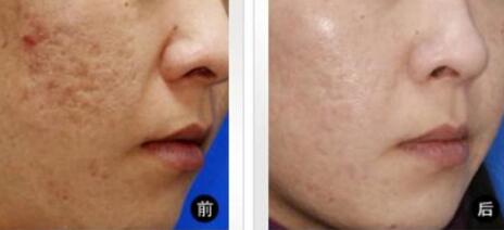 臺州納米微針去額頭紋真實費用(臺州星范醫(yī)療美容納米微針去額頭紋參考價：5138元)