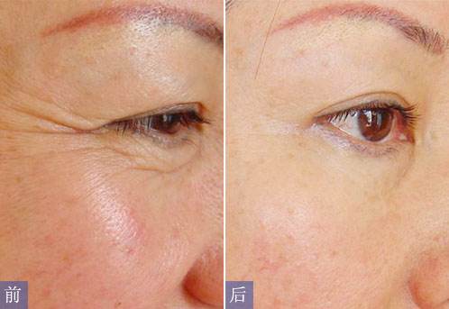 昆山大拉皮去動態(tài)細(xì)紋的手術(shù)費(fèi)用一般需要多少錢(昆山德爾美客醫(yī)療美容門診部大拉皮去動態(tài)細(xì)紋參考價(jià)：6936元)