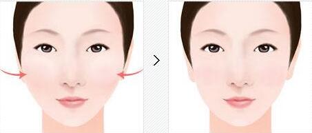 西安膠原蛋白注射豐唇部價格