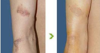 重慶減肥瘦臉針價(jià)格