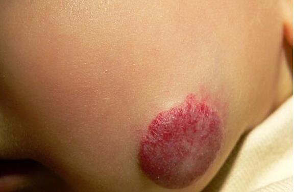 宿州減輕額頭皺紋價位表詳細展示(宿州埇橋區(qū)東關(guān)辦事處衛(wèi)生院減輕額頭皺紋參考價：6720元)