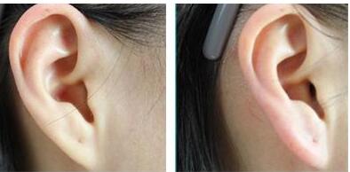 上海射頻去除印第安紋收費價格清單一覽(上海星氧醫(yī)療美容門診部射頻去除印第安紋參考價：4806元)