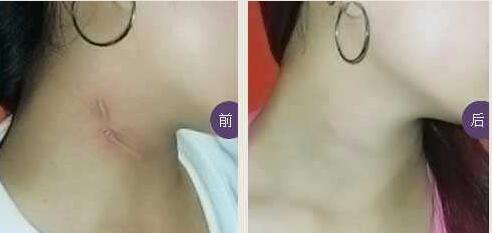 寧波水柔隆胸術手術價格驚喜爆出(寧波海曙初美醫(yī)療美容門診部水柔隆胸術參考價：4804元)