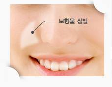 長(zhǎng)沙自體脂肪填充太陽(yáng)穴的價(jià)格一般需要多少錢(長(zhǎng)沙美加美學(xué)醫(yī)療美容診所自體脂肪填充太陽(yáng)穴參考價(jià)：4549元)