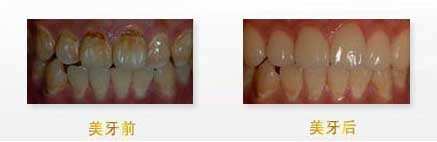 焦作鼻基底填充假體的價(jià)格一般要多少錢合理(焦作完美儷人醫(yī)療美容機(jī)構(gòu)鼻基底填充假體參考價(jià)：5748元)