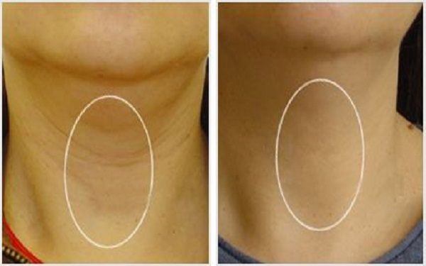 遂寧超聲刀去除皺紋整形價錢一覽表剖析(遂寧因恩因禾美容醫(yī)療門診部超聲刀去除皺紋參考價：3469元)