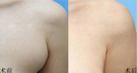 無錫注射botox去除面部皺紋價格