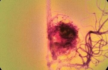 南京玻尿酸打直角肩價(jià)格