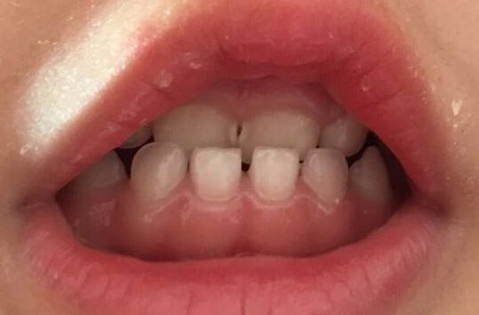 脖子粗想變天鵝頸？貴陽華美整形幫你解決困擾