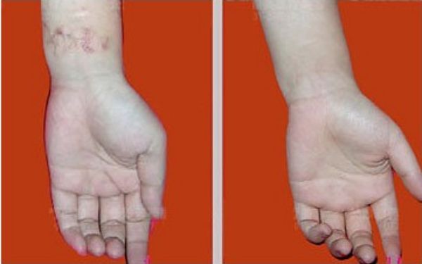 南京藝星超聲炮體驗(yàn)分享，周敏醫(yī)生值得信賴！