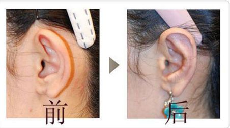 上海華山醫(yī)院顴骨整形效果如何？優(yōu)秀醫(yī)生推薦