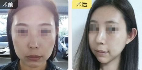 雙眼皮塑美，昆明藝星技術(shù)大揭秘，價格詳盡一覽